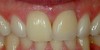 Dental Implants Before & After Image