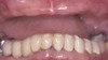 Dental Implants Before & After Image