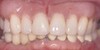 Dental Implants Before & After Image