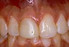 Porcelain Crowns Before & After Image