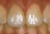 Porcelain Crowns Before & After Image