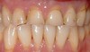 Porcelain Crowns Before & After Image