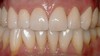 Porcelain Crowns Before & After Image